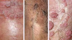 Hình ảnh sùi mào gà (Herpes sinh dục)