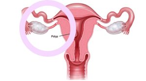 Kinh ra ồ ạt, dấu hiệu của Polyp cổ tử cung