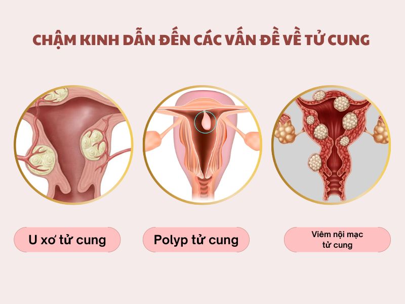 Chậm kinh 5 ngày dẫn đến các vấn đề về tử cung