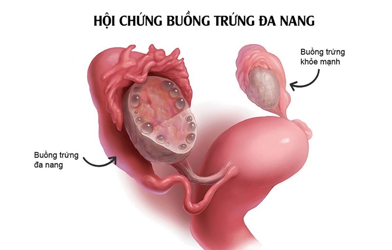 Hội chứng buồng trứng đa nang là một rối loạn nội tiết phổ biến ở nữ giới