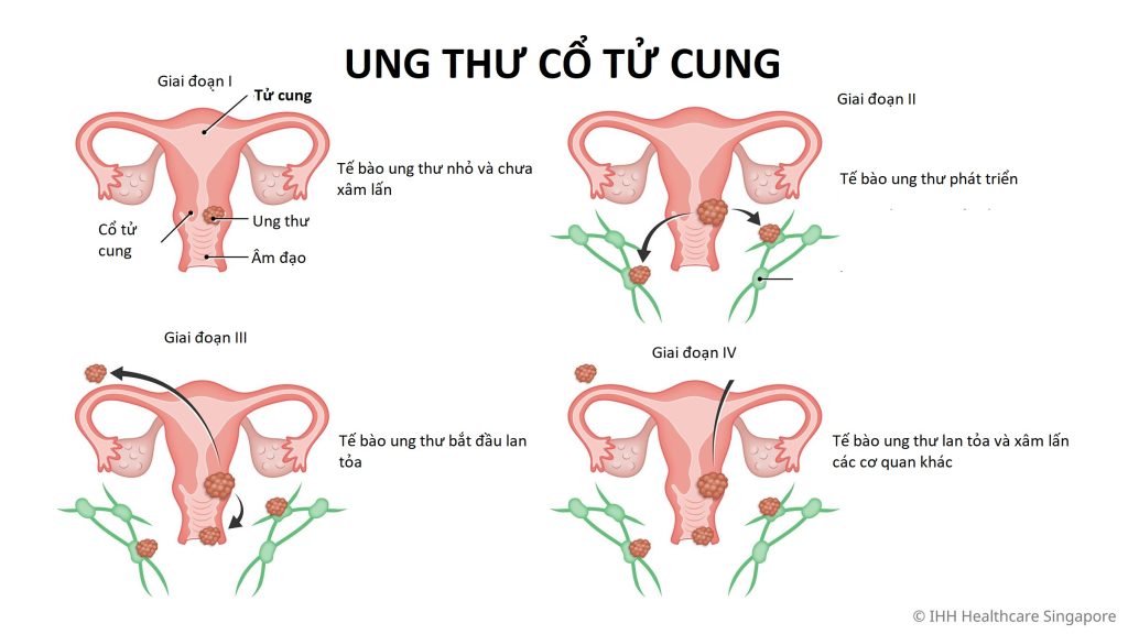 Hình ảnh ung thư cổ tử cung các giai đoạn