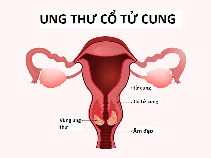 Hình ảnh ung thư cổ tử cung  