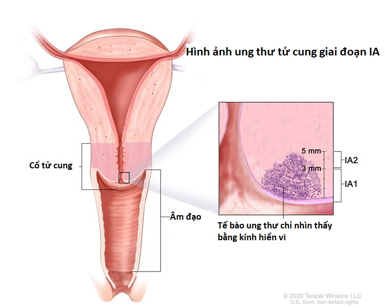 Hình ảnh ung thư cổ tử cung giai đoạn IA