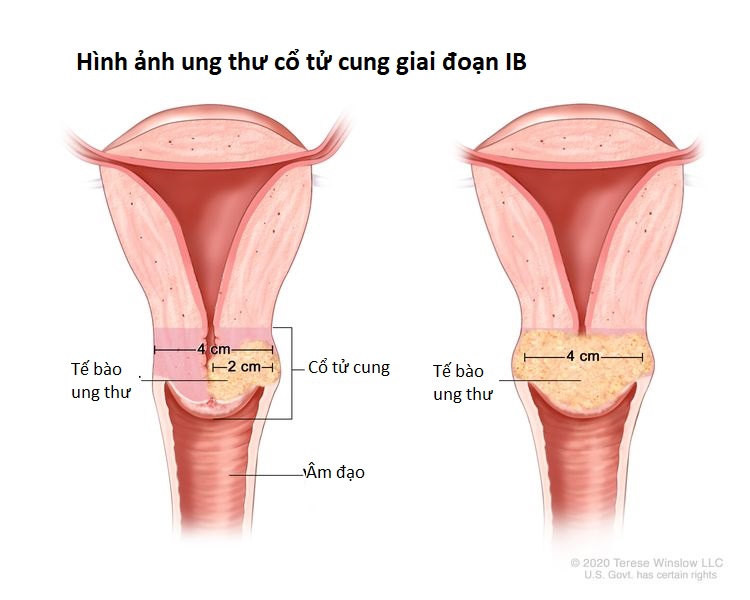 Hình ảnh ung thư cổ tử cung giai đoạn IB