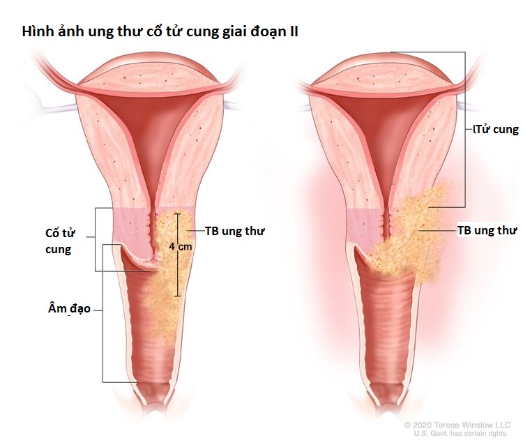 Hình ảnh ung thư cổ tử cung giai đoạn II