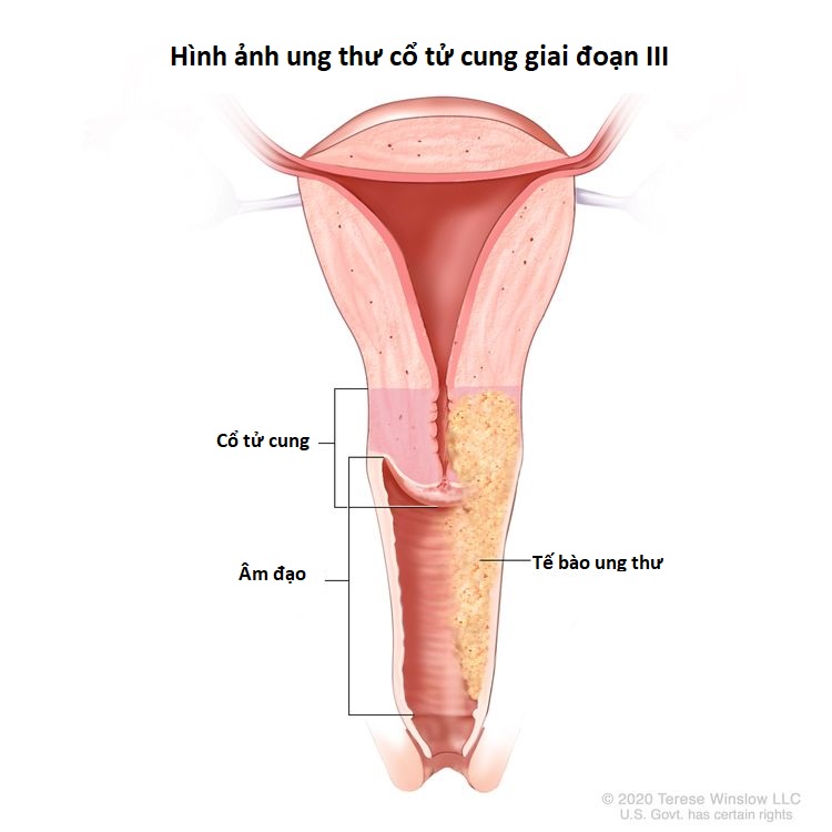 Hình ảnh ung thư cổ tử cung giai đoạn III