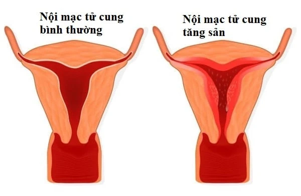 Tăng sinh nội mạc tử cung có thể diễn tiến thành ung thư