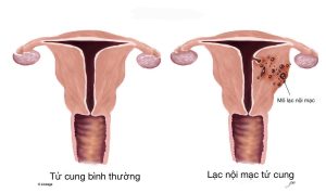 Lạc nội mạc tử cung