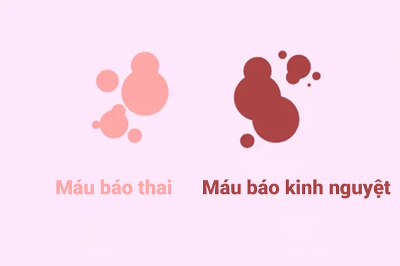 Phân biệt máu rong kinh và máu báo thai