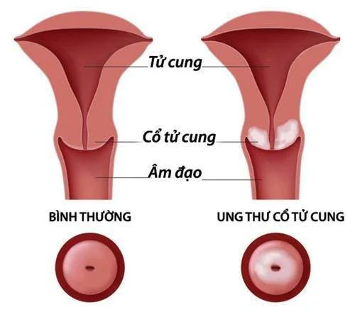 Ung thư cổ tử cung hình thành từ sự phát triển không bình thường của các tế bào biểu mô