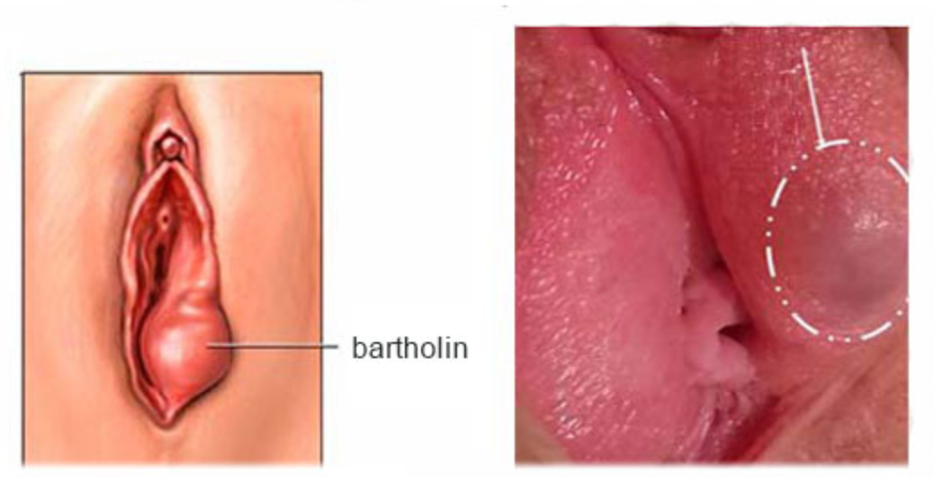 Nổi cục ở mép âm đạo có thể là dấu hiệu của viêm tuyến Bartholin