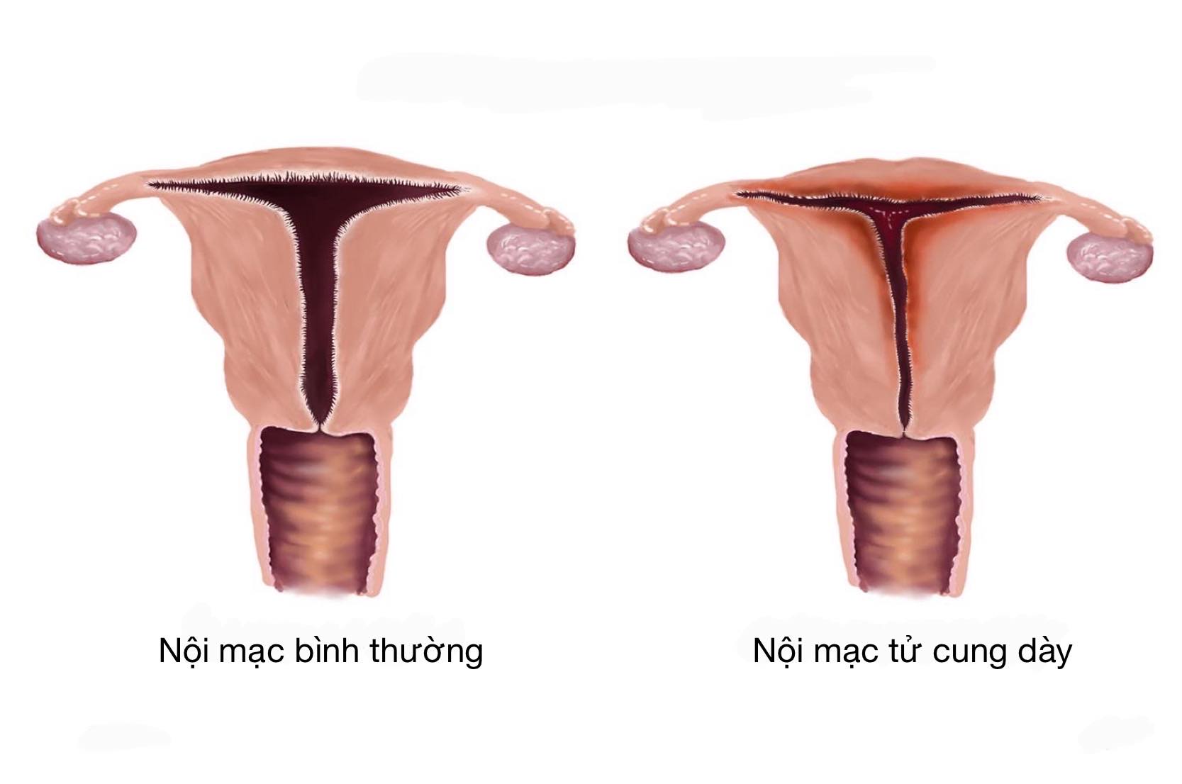 Nội mạc tử cung dày gây rong kinh