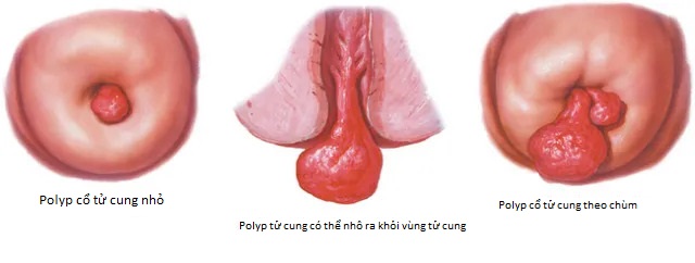 Hình ảnh polyp cổ tử cung