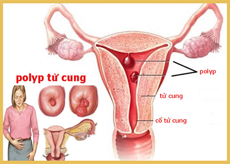 Rong kinh là dấu hiệu của polyp tử cung