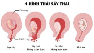 Rong kinh sau khi sảy thai tự nhiên có nguy hiểm không?