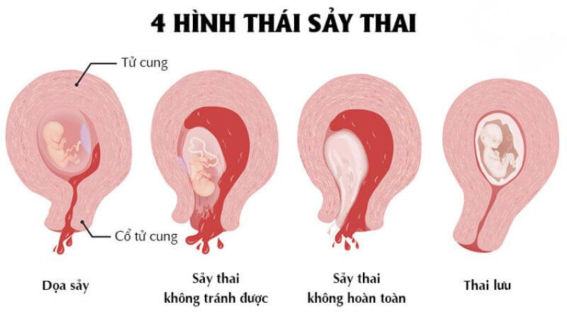 4. Cách chăm sóc cơ thể sau sảy thai