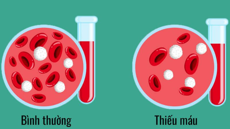 Thiếu máu là biến chứng hay gặp của rong kinh