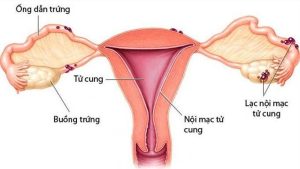 U lạc nội mạc tử cung buồng trứng là tình trạng nội mạc tử cung phát triển tại buồng trứng