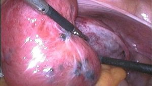 Nội soi để loại bỏ nang là phương pháp thường được thực hiện khi phẫu thuật