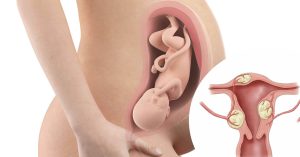 Tình trạng u xơ tử cung khi mang thai là tình trạng không hề hiếm gặp