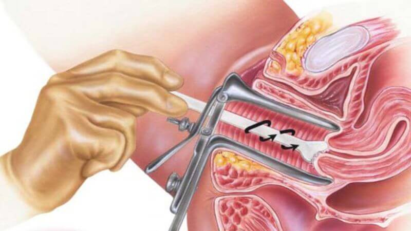 Chị em nên tầm soát ung thư cổ tử cung để tránh nguy cơ mắc bệnh