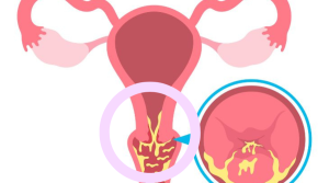 Tái tạo cổ tử cung là gì? Mối liên hệ với bệnh viêm lộ tuyến cổ tử cung