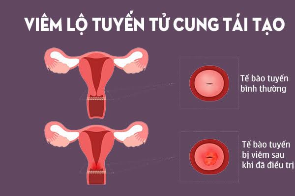 Quá trình tái tạo cổ tử cung sẽ diễn ra nếu viêm lộ tuyến được điều trị sớm và đúng cách