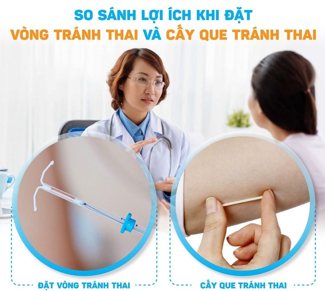 Nên đặt vòng hay cấy que tránh thai