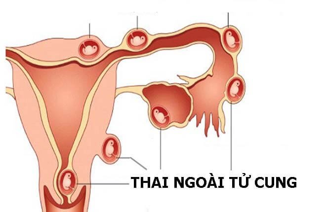 Chửa ngoài tử cung gây đau bụng