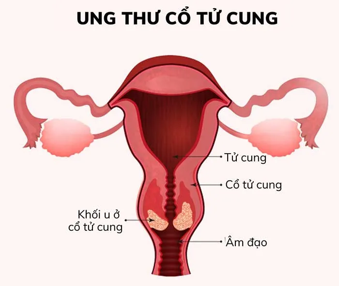 Viêm lộ tuyến cổ tử cung nếu không được điều trị và tái phát nhiều lần có thể gây ung thư