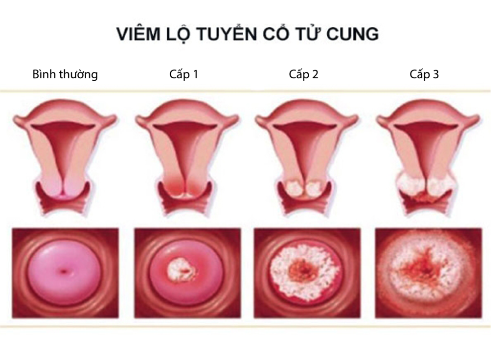 Phân tích ca bệnh điều trị lộ tuyến bằng đốt điện CTC