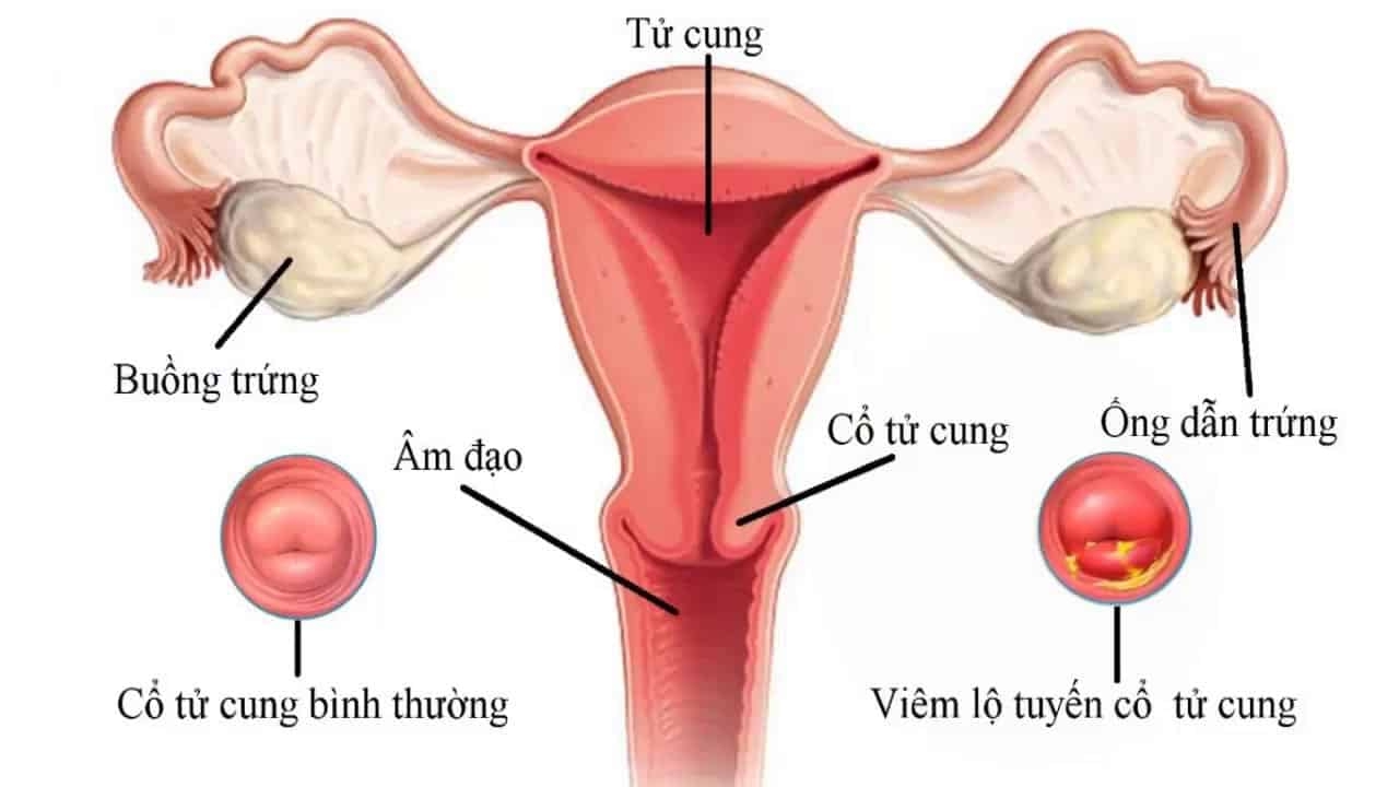 Lộ tuyến cổ tử cung là tình trạng hay gặp ở phụ nữ