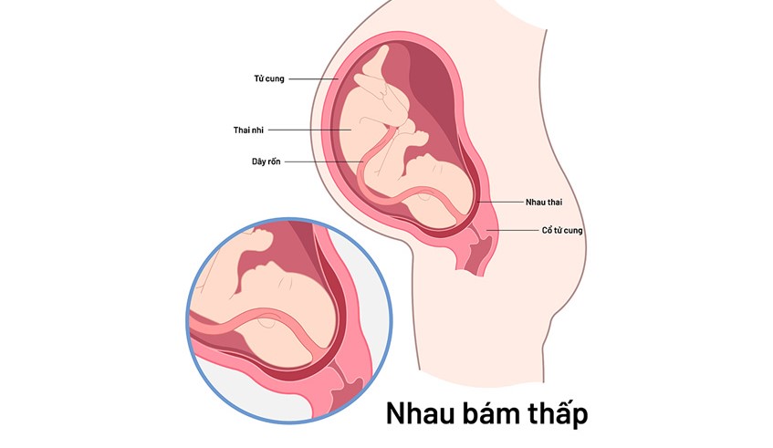 Nhau thai bám thấp được phát hiện vào khoảng tuần thứ 28 của thai kỳ