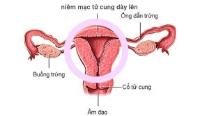 Tại sao nội mạc tử cung dày gây rong kinh?