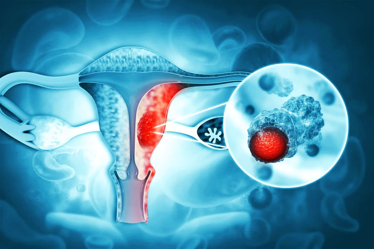 Sarcoma tử cung