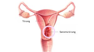 Sarcoma tử cung: Nguyên nhân, triệu chứng, chẩn đoán, điều trị
