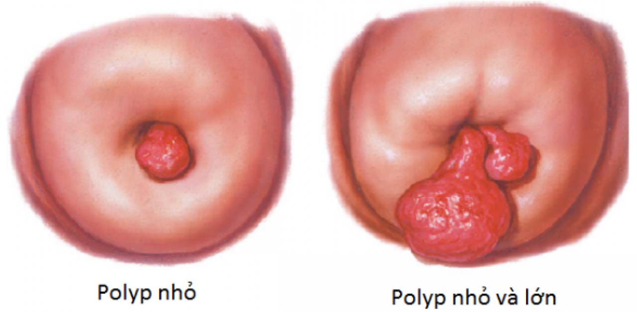 Polyp cổ tử cung thường không có triệu chứng rõ ràng