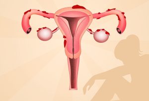 Thành sau niêm mạc tử cung có khối u nguy hiểm không?