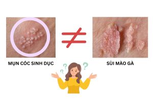 mụn cóc sinh dục và sùi mào gà