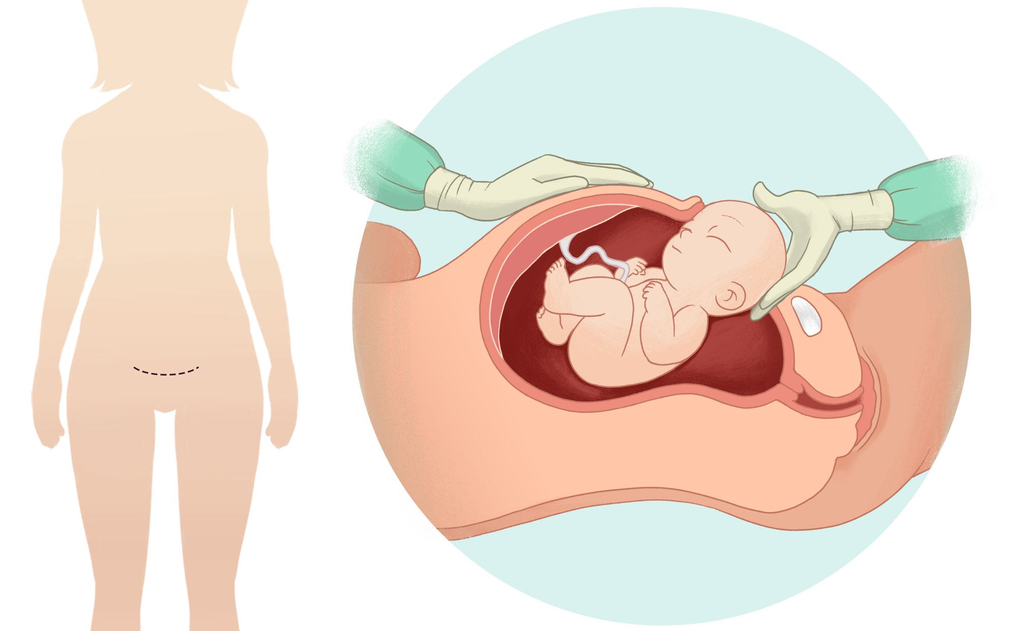 Bác sĩ có thể mổ lấy thai nếu triệu chứng rau tiền đạo nghiêm trọng 