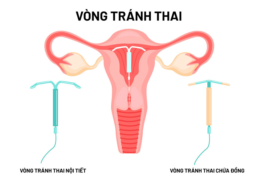 Hai loại vòng tránh thai phổ biến hiện nay