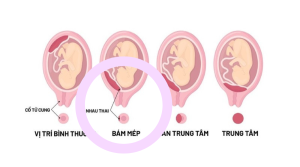 Cách cầm máu khi bị nhau tiền đạo hiệu quả