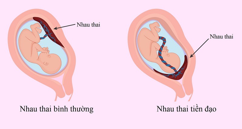 Nhau tiền đạo là hiện tượng nhau thai bám ở vị trí bất thường trong buồng tử cung