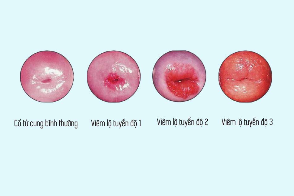 Viêm lộ tuyến độ 3 có thể được chỉ định đốt điện viêm lộ tuyến cổ tử cung