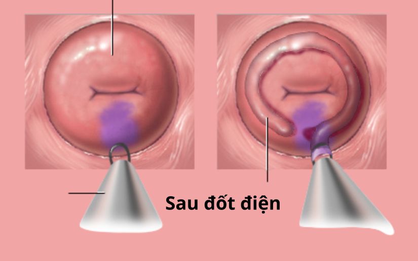 7. Câu hỏi thường gặp về đốt điện cổ tử cung