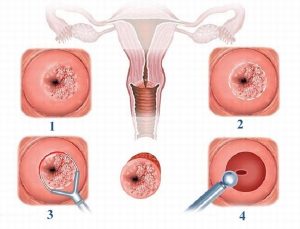 đốt viêm lộ tuyến cổ tử cung