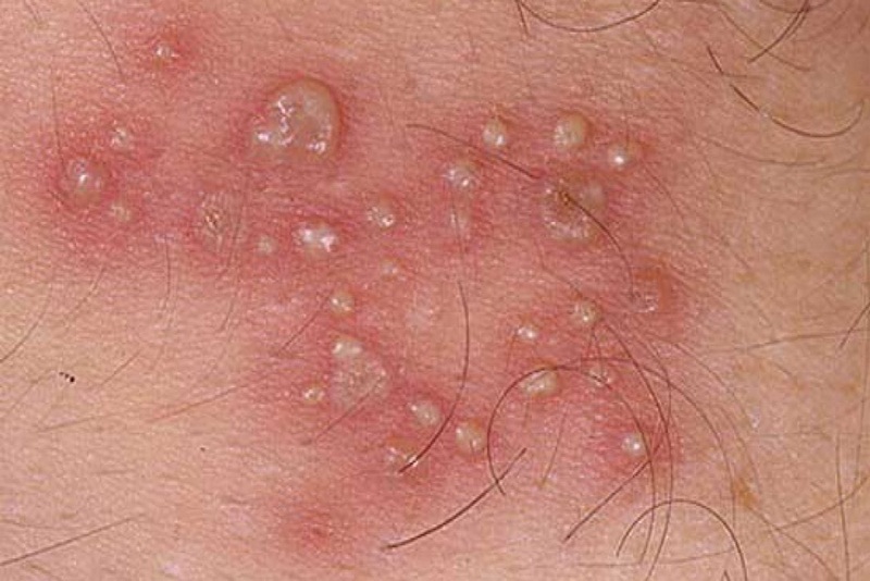 Biểu hiện của herpes sinh dục có thể là các đợt mụn rộp bùng phát