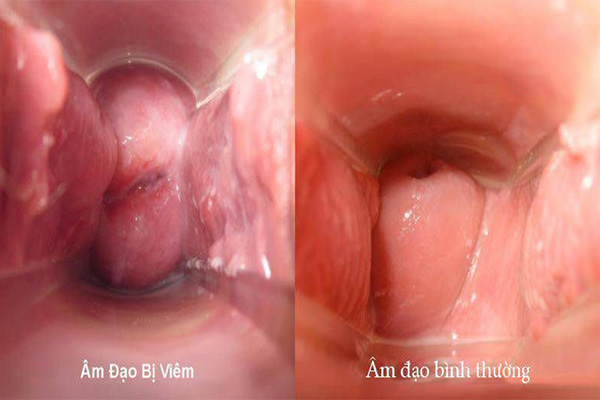 Việc điều trị đúng giúp âm đạo nhanh chóng trở lại bình thường