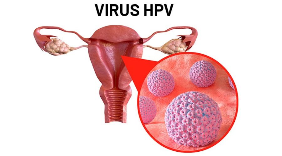 Virus HPV là nguyên chính dẫn đến bệnh sùi mào gà