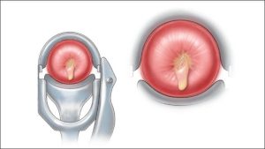 Viêm cổ tử cung khi cho con bú